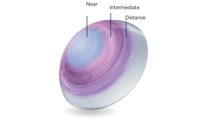 Diagram of a multifocal soft contact lens showing near, intermediate and distance vision zones