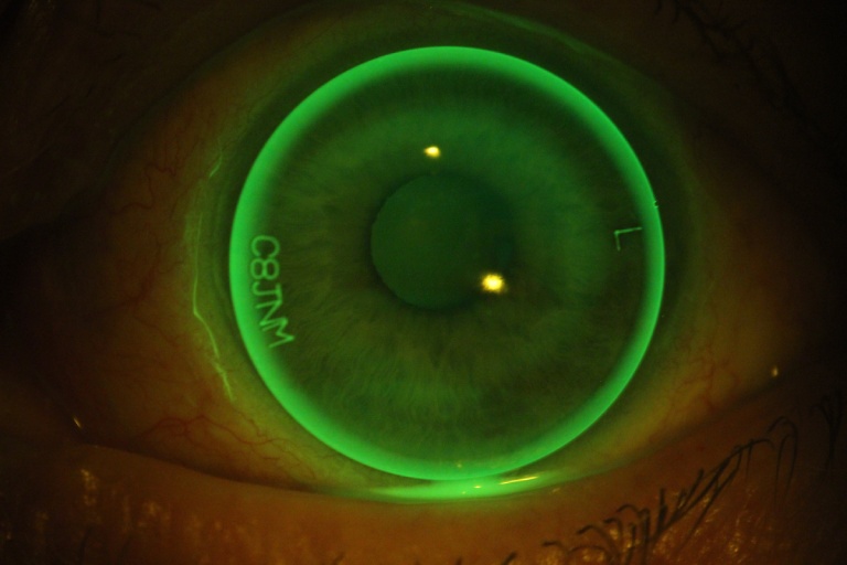 Fluorescein fitting assessment of a rigid gas permeable contact lens on the eye