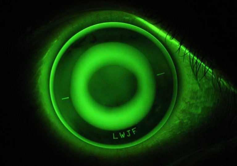 Orthokeratology lens on the eye under green fluorescein light