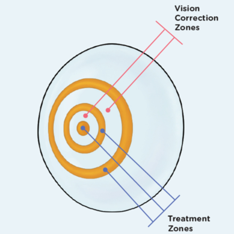 Diagram of a myopia-control soft contact lens showing vision-correction zones and surrounding treatment zones