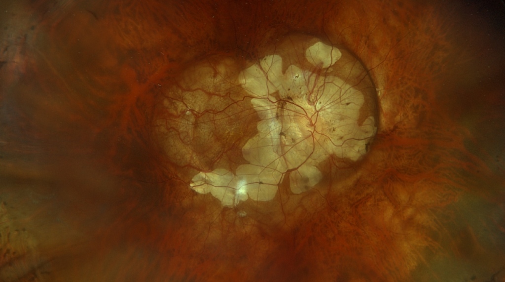 Retinal photograph showing advanced degenerative changes associated with pathological myopia
