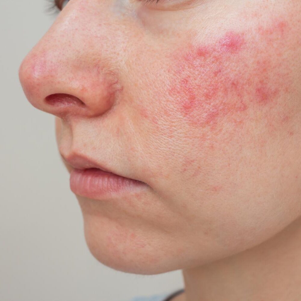 Facial rosacea with redness and inflammation across the cheeks and nose