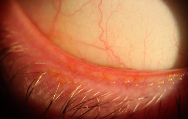 Close-up image showing eyelid margin inflammation and blocked meibomian gland openings