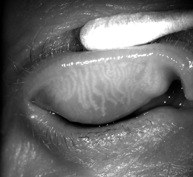 Meibography image showing disorganised meibomian glands in an eyelid with meibomian gland dysfunction