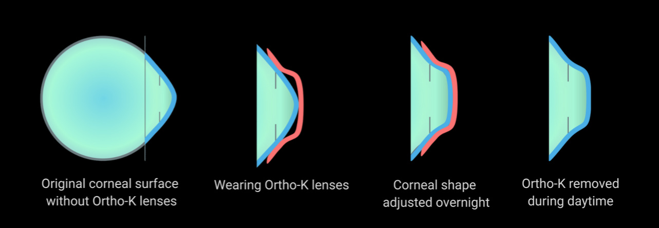 Diagram showing an orthokeratology lens temporarily reshaping the cornea overnight before lens removal
