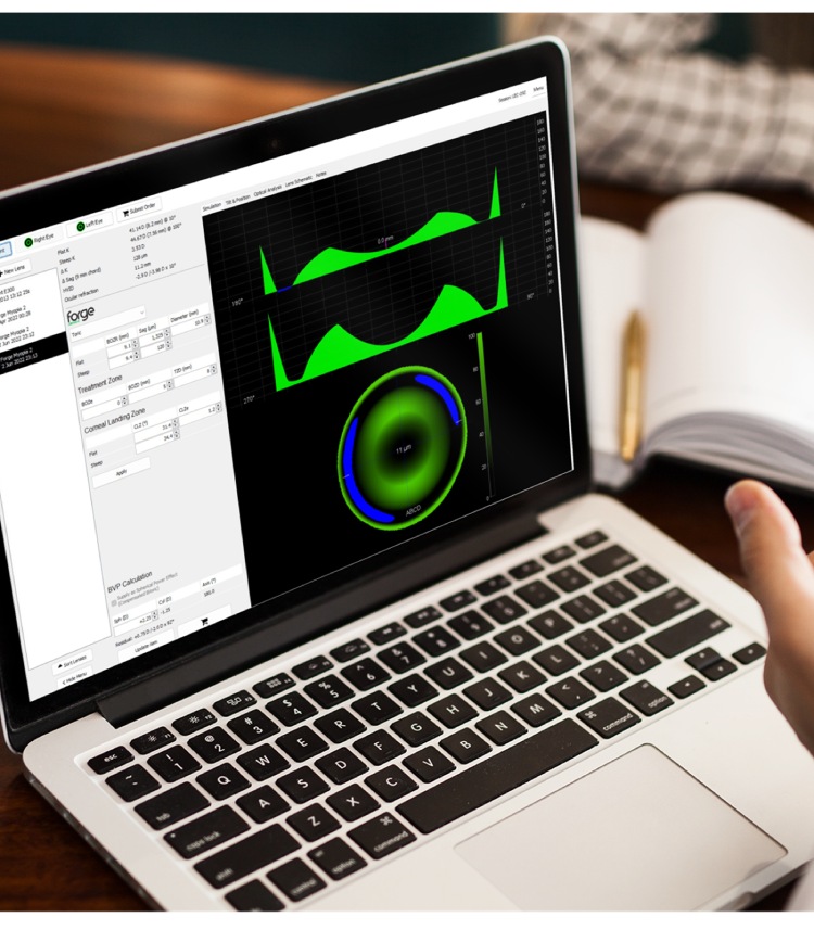Forge OrthoK software displaying a customised orthokeratology lens design and treatment-zone simulation