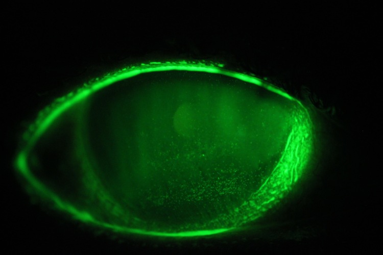 Fluorescein image of a scleral lens fitted on an eye with dry eye disease