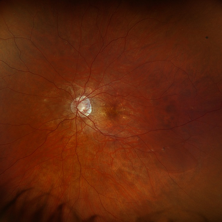 Wide-field retinal image used to monitor eye health in a person with high myopia