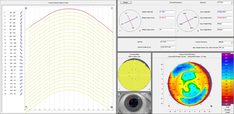 Cornea scleral profile scan and elevation map captured using the Pentacam AXL Wave