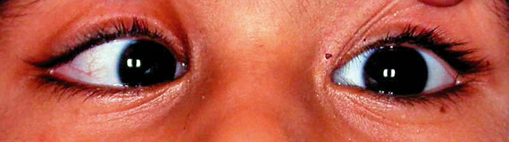 Close-up of a child with an inward eye turn, known as strabismus