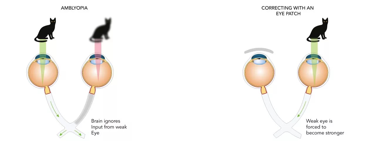 Diagram showing how patching the stronger eye encourages the weaker eye to develop better vision in amblyopia