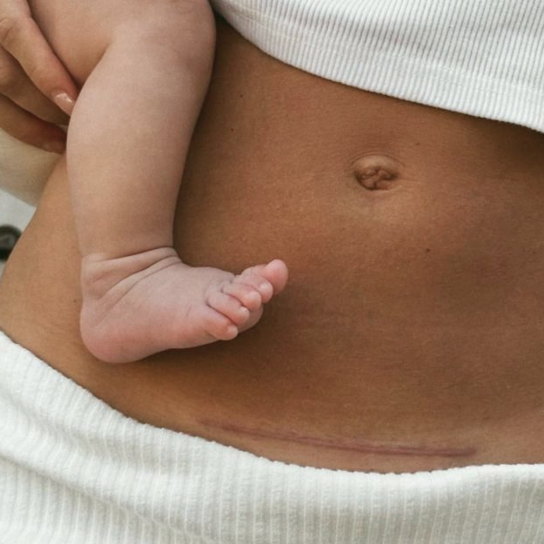 scar-revision; subcision; TCA-cross