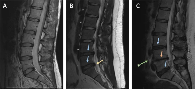 Genetics of intervertebral disc degeneration phases visualization