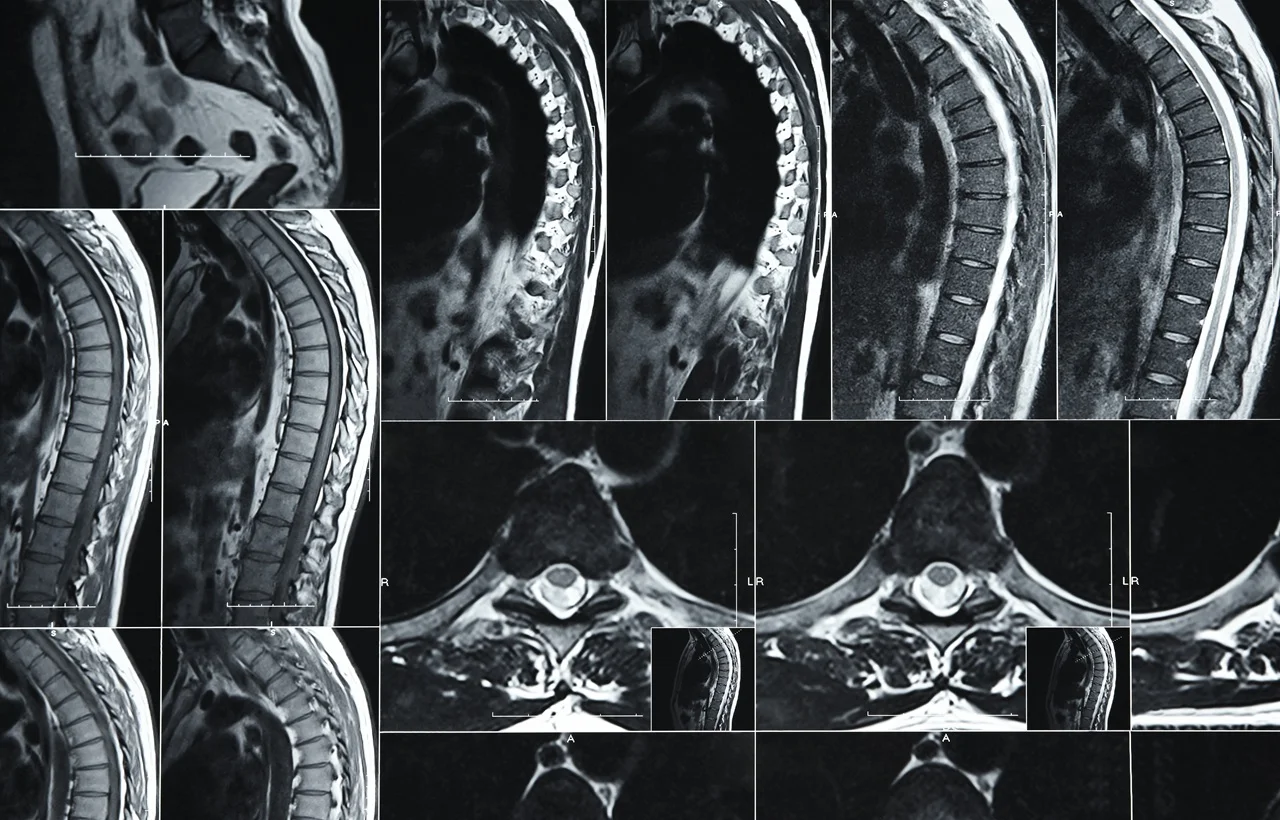 Limitless Chiropractic digital X-ray showing a lumbar disc herniation in an Austin patient