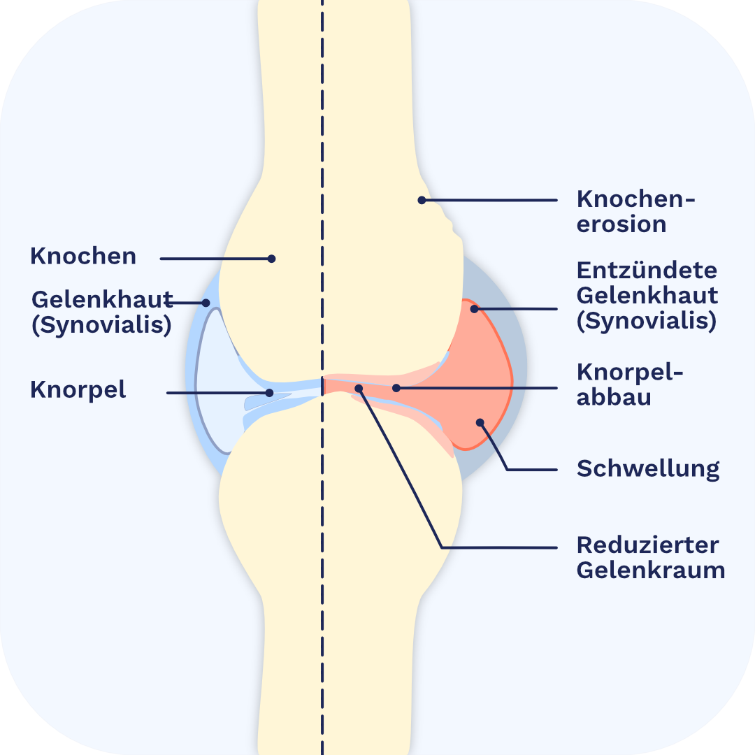 Aufbau eines Gelenks und Veränderungen bei Rheumatoider Arthritis