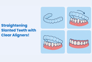 Aligner process of straightening teeth 