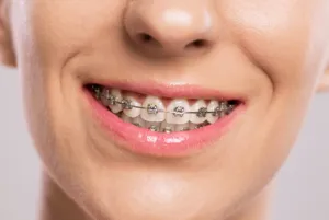  A girl smiling with metal braces.