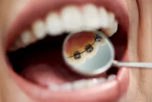  A Close-up of a woman with Lingual Braces during her dental exam.