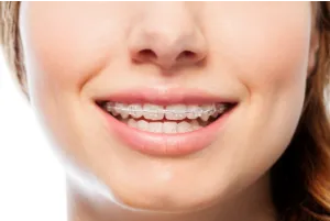  A girl wearing ceramic braces.