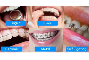 An image shows different types of braces
