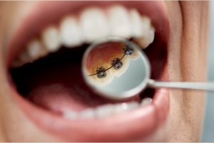 Woman with lingual braces
