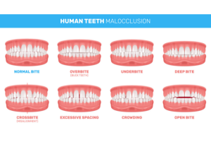 Types of malocclusions lingual braces can treat