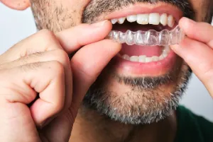 A close-up of a man applying clear aligners.