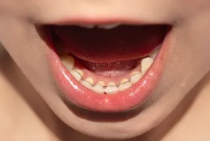 A girl with an open mouth showing permanent retainers