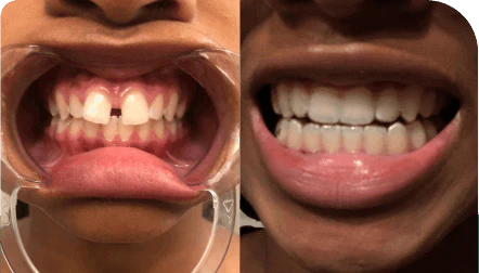 Invisalign Review Invisalign Review