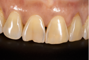 A close-up of a chipped front tooth