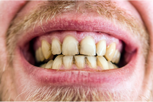 A close-up of a person’s weak, stained teeth