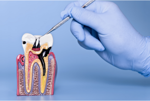 A model of a tooth with a severe cavity.