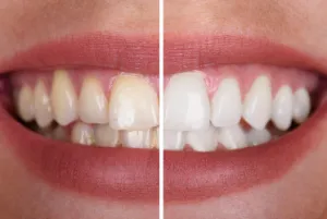 Discolored teeth before and after whitening