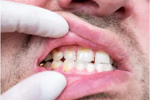 A person experiencing a toothache