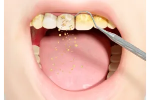 Tartar cleaning illustration