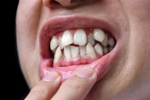 A person with misaligned teeth.