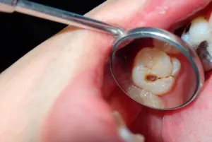 Tooth cavity in back teeth
