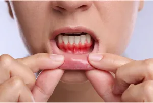 A woman showing her inflamed gums.
