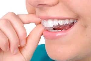 A zoomed-in picture of a woman wearing clear aligners