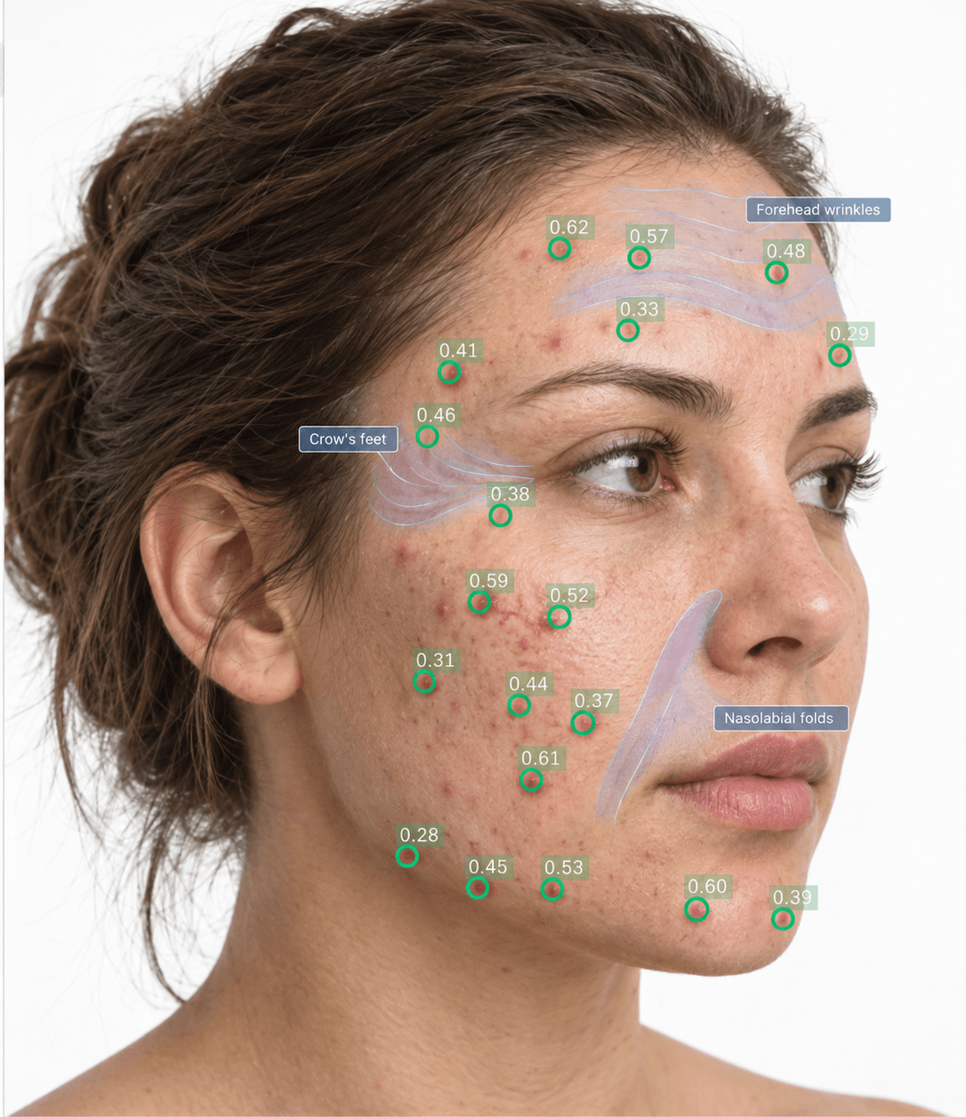 Annotated training image: detected blemishes with confidence values and labeled line regions on the forehead, crow's feet and nasolabial folds