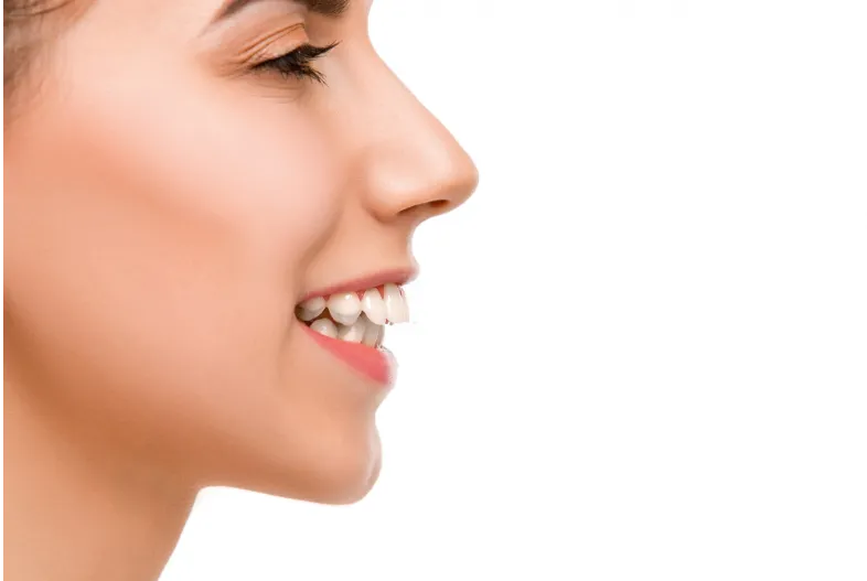 Side pose of a girl smiling and showing teeth with an overbite 