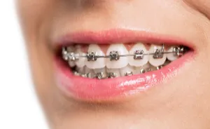 Side pose of a girl smiling and showing teeth with an overbite 
