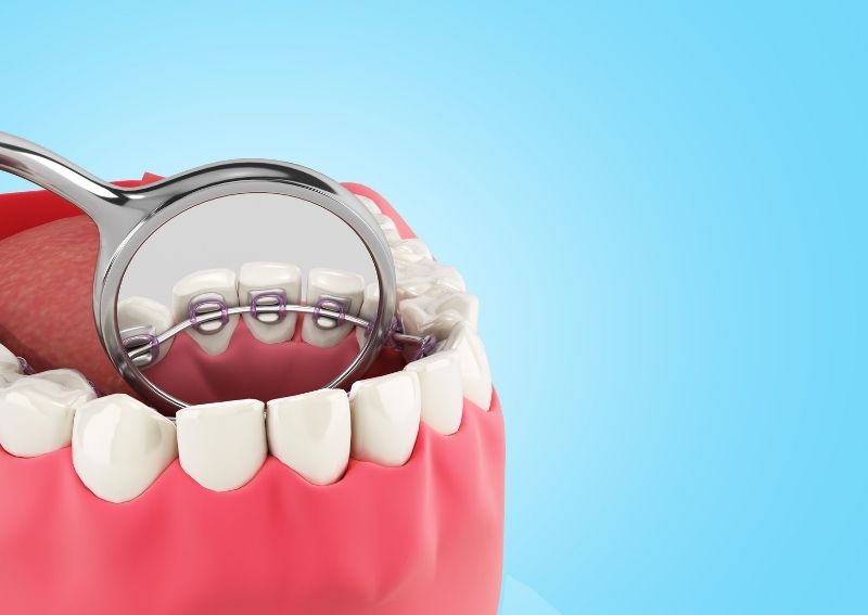 lingual braces