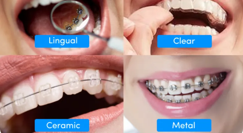 All types of ways of straightening teeth