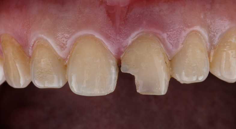 A close-up of a chipped front tooth