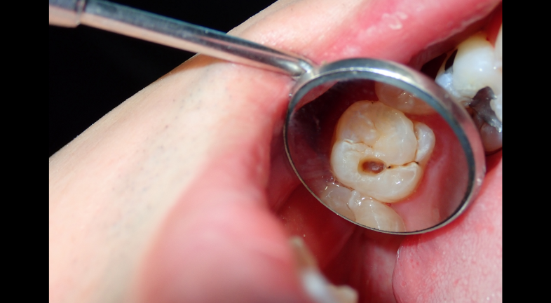 A tooth model biting a walnut 