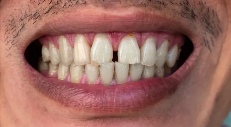 A close-up of a man suffering from aligners gaps in the front teeth.