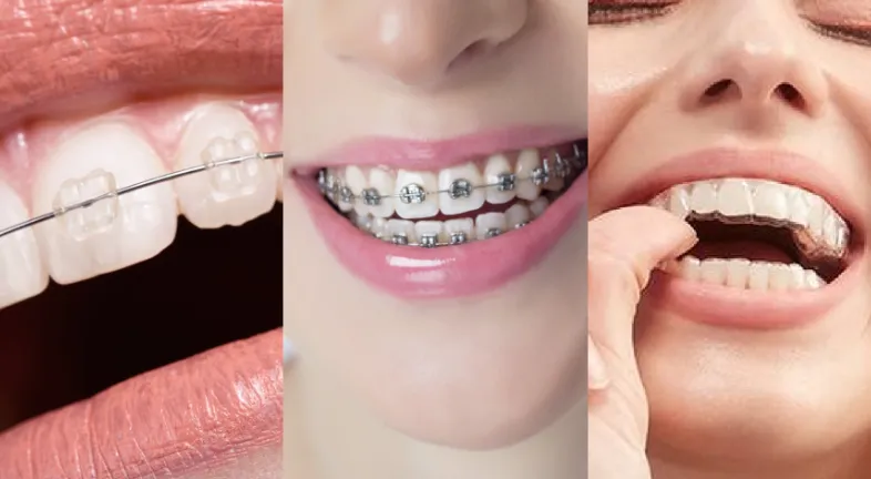 The best ways to straighten teeth.