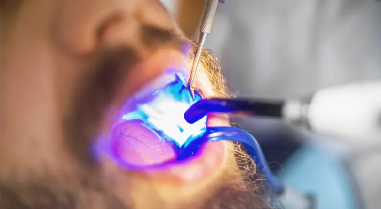 A dentist using the curing light to harden dental bonding