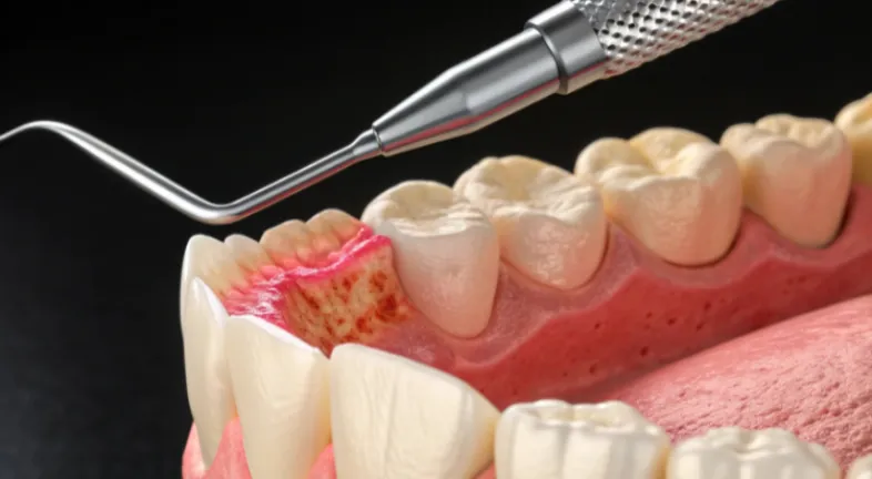 A dental tool probing a diseased gum.